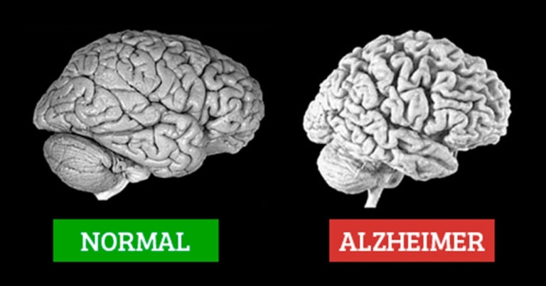 ALZHEIMER ANTES DOS TRINTA ANOS: QUATRO SINTOMAS COMUNS PARA FICAR DE OLHO