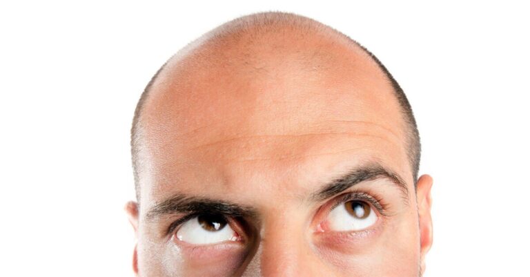 FIM DOS CARECAS? CIENTISTAS CRIAM PRODUTO QUE FAZ O CABELO VOLTAR A CRESCER